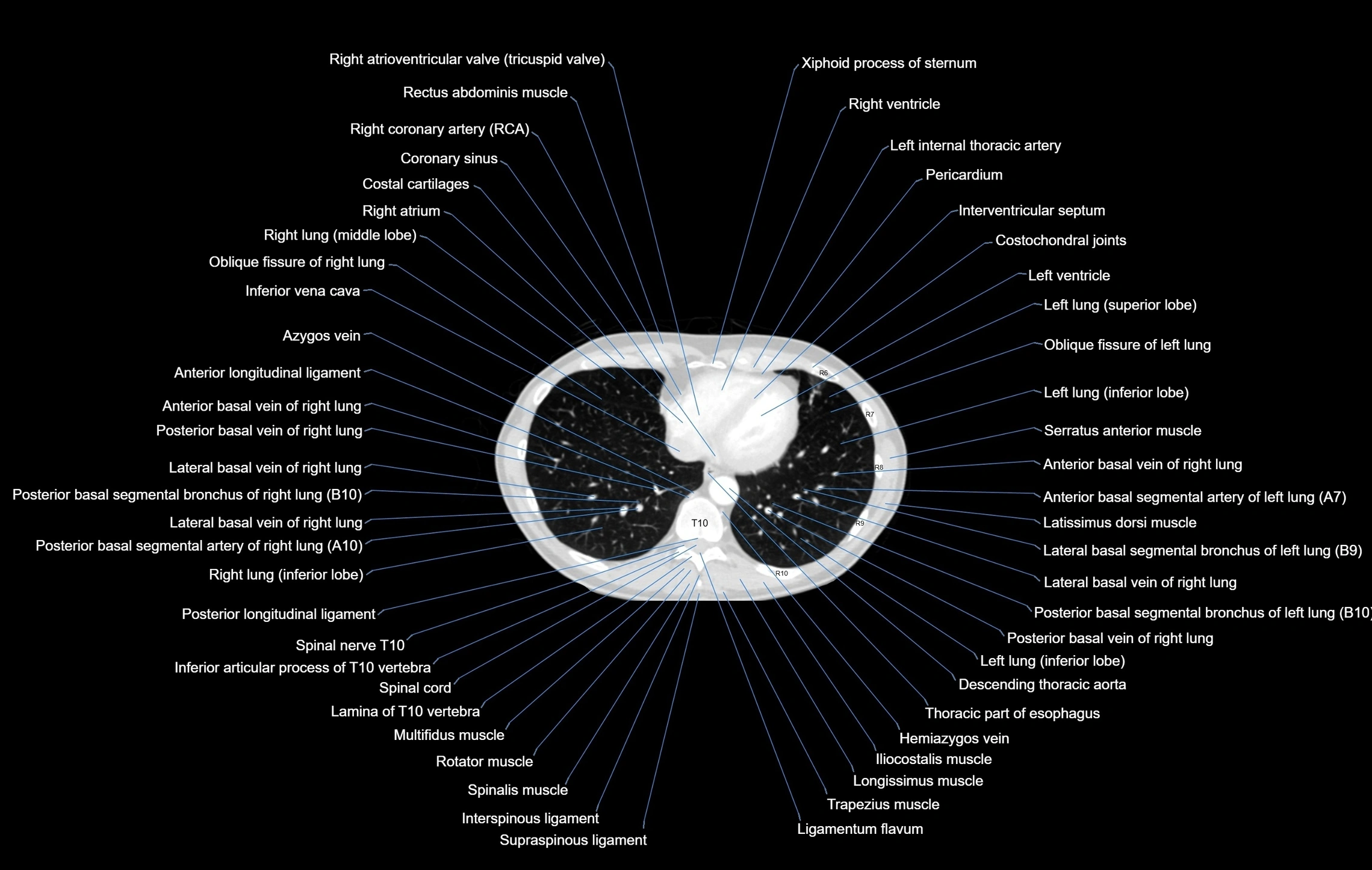 CT chest (thorax) lung window window labelled axial cross sectional anatomy radiology image-00089.webp